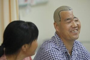 Chinese doctors to rebuild man’s skull using 3D-printing