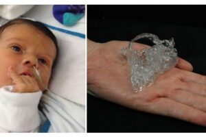3D-printed heart saves baby’s life